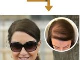 Hairstyles to Cover Bald Spots for Women 12 Best Female Pattern Baldness Images On Pinterest In 2018