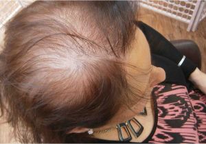 Hairstyles to Cover Bald Spots for Women Thinning Locks and Bald Patches the Hidden Horrors Of Female Hair