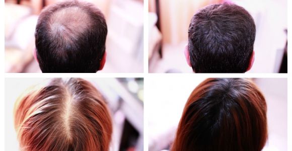 Hairstyles to Cover Up Hair Loss How to Cover Up Hair Loss Bald Spots Thinning Hair Receding