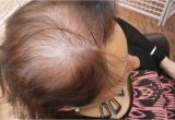 Hairstyles to Cover Up Hair Loss Thinning Locks and Bald Patches the Hidden Horrors Of Female Hair