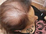 Hairstyles to Cover Up Hair Loss Thinning Locks and Bald Patches the Hidden Horrors Of Female Hair